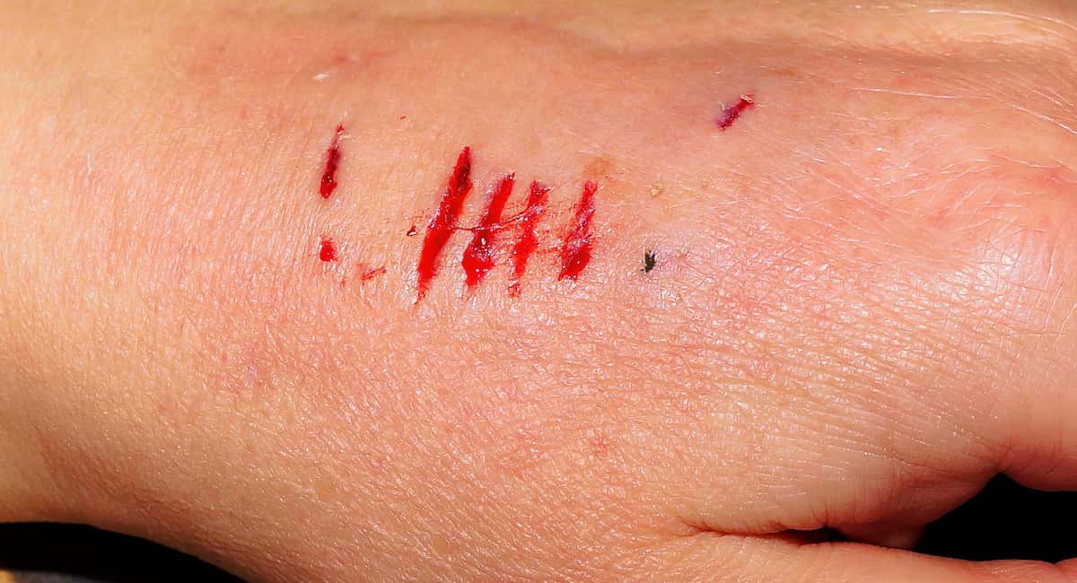 Determining liability for a dog bite injury
